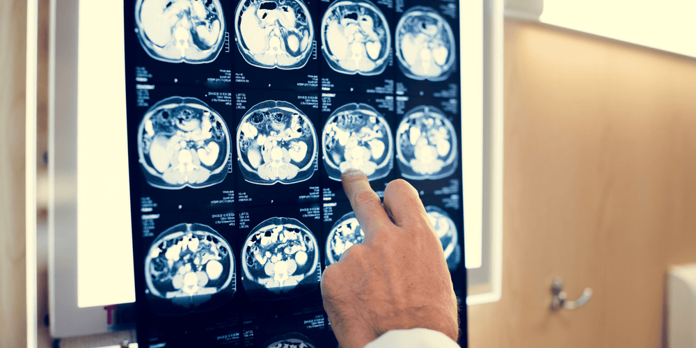 doctor pointing at brain scans discussing the most common neurodegenerative disease