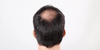The back of a balding man looking for hair loss treatments 